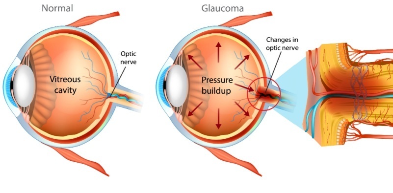 Diagram of the inside of the eye showing how glaucoma changes the optic nerve